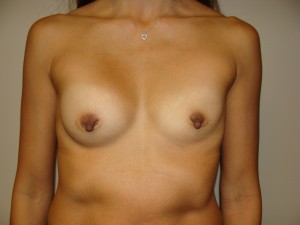 Breast Revision Before and After 48 | Sanjay Grover MD FACS