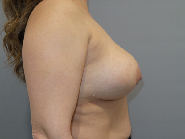 Breast Revision Before and After 59 | Sanjay Grover MD FACS