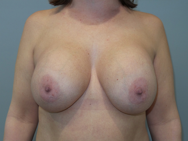 Breast Revision Before and After 01 | Sanjay Grover MD FACS