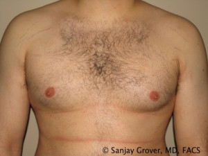 Gynecomastia Before and After 22 | Sanjay Grover MD FACS