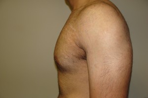 Gynecomastia Before and After 12 | Sanjay Grover MD FACS