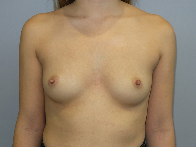 Hybrid Breast Augmentation Before and After 02 | Sanjay Grover MD FACS