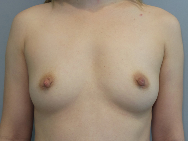 Hybrid Breast Augmentation Before and After | Sanjay Grover MD FACS