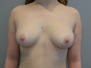 Hybrid Breast Augmentation Before and After | Sanjay Grover MD FACS