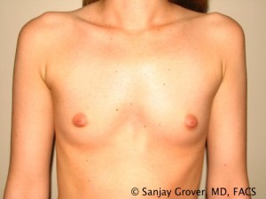 Mini Breast Augmentation Before and After 07 | Sanjay Grover MD FACS