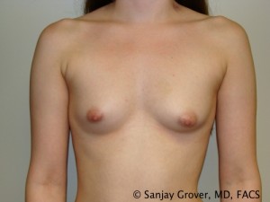 Mini Breast Augmentation Before and After 12 | Sanjay Grover MD FACS