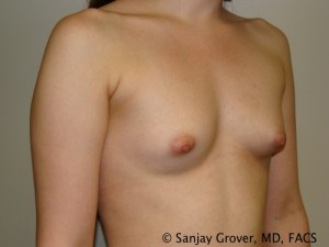 Mini Breast Augmentation Before and After 06 | Sanjay Grover MD FACS