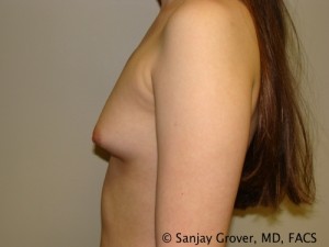 Mini Breast Augmentation Before and After 06 | Sanjay Grover MD FACS