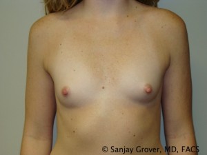 Mini Breast Augmentation Before and After 12 | Sanjay Grover MD FACS