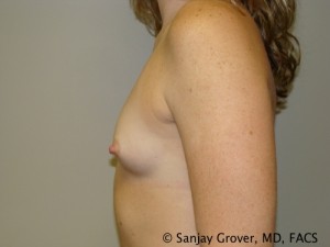 Mini Breast Augmentation Before and After 09 | Sanjay Grover MD FACS