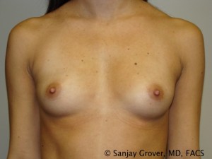 Mini Breast Augmentation Before and After 08 | Sanjay Grover MD FACS