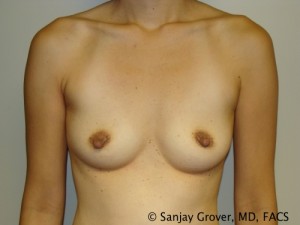 Mini Breast Augmentation Before and After 07 | Sanjay Grover MD FACS