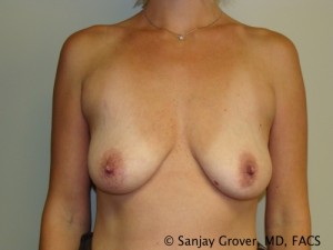 Mini Breast Lift Before and After 22 | Sanjay Grover MD FACS