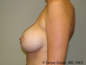 Mini Breast Lift Before and After 05 | Sanjay Grover MD FACS