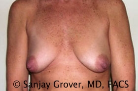 Mini Breast Lift Before and After 07 | Sanjay Grover MD FACS