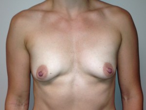 Mini Breast Lift Before and After 02 | Sanjay Grover MD FACS