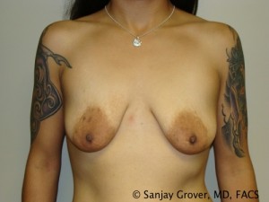 Mini Breast Lift Before and After 05 | Sanjay Grover MD FACS