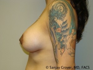 Mini Breast Lift Before and After 16 | Sanjay Grover MD FACS