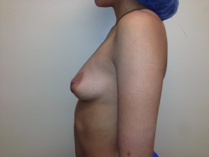 Mini Breast Lift Before and After 19 | Sanjay Grover MD FACS