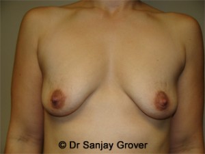 Mini Breast Lift Before and After 02 | Sanjay Grover MD FACS