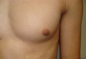 Nipple Reduction Before and After 05 | Sanjay Grover MD FACS