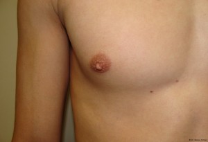 Nipple Reduction Before and After 05 | Sanjay Grover MD FACS