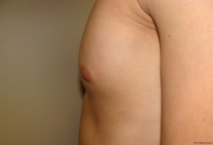 Nipple Reduction Before and After 05 | Sanjay Grover MD FACS