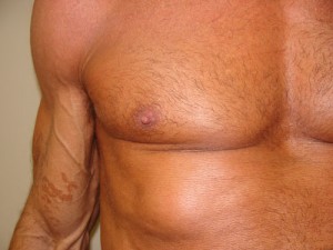 Nipple Reduction Before and After 09 | Sanjay Grover MD FACS