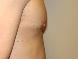 Nipple Reduction Before and After 10 | Sanjay Grover MD FACS