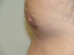 Nipple Reduction Before and After 10 | Sanjay Grover MD FACS