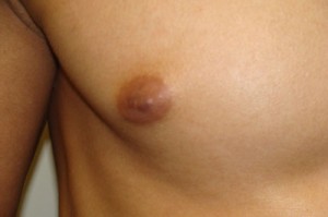 Nipple Reduction Before and After 12 | Sanjay Grover MD FACS