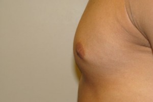 Nipple Reduction Before and After 12 | Sanjay Grover MD FACS