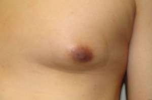 Nipple Reduction Before and After 13 | Sanjay Grover MD FACS