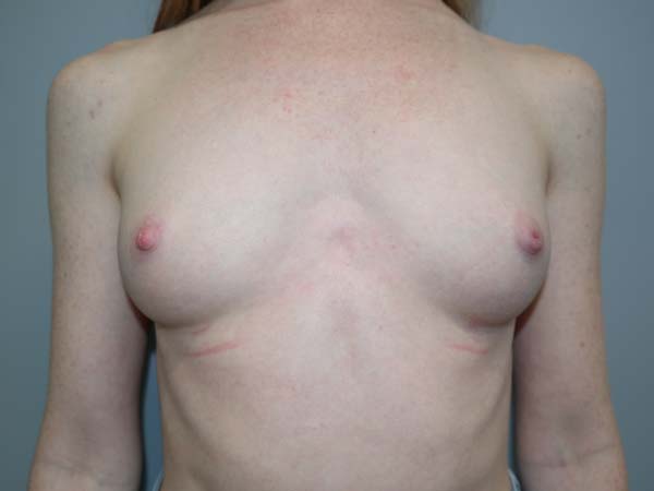 Scarless Breast Augmentation Before and After 10 | Sanjay Grover MD FACS