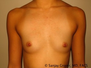 Scarless Breast Augmentation Before and After 09 | Sanjay Grover MD FACS