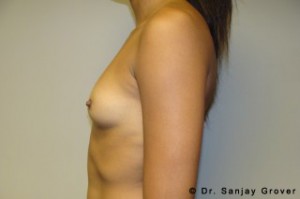 Scarless Breast Augmentation Before and After 06 | Sanjay Grover MD FACS