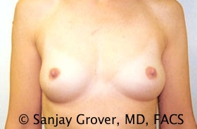 Scarless Breast Augmentation Before and After 12 | Sanjay Grover MD FACS