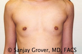 Scarless Breast Augmentation Before and After 10 | Sanjay Grover MD FACS