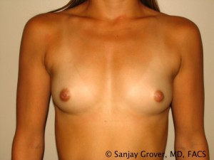 Scarless Breast Augmentation Before and After 02 | Sanjay Grover MD FACS