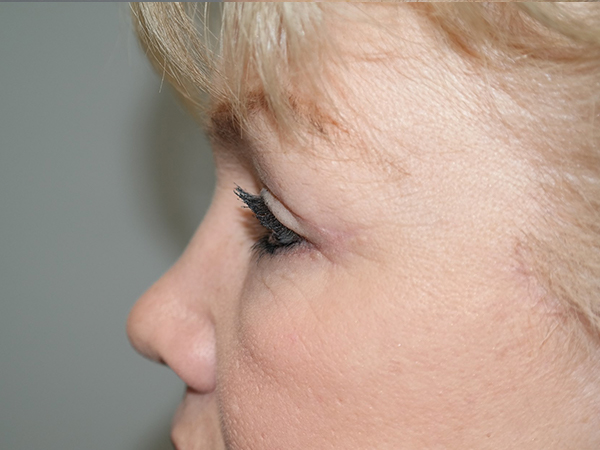 Blepharoplasty Before and After 02 | Sanjay Grover MD FACS