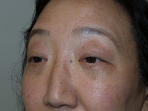 Blepharoplasty Before and After 03 | Sanjay Grover MD FACS