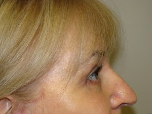 Blepharoplasty Before and After 06 | Sanjay Grover MD FACS