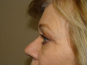 Blepharoplasty Before and After 08 | Sanjay Grover MD FACS