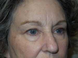 Blepharoplasty Before and After 12 | Sanjay Grover MD FACS