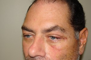 Blepharoplasty Before and After 15 | Sanjay Grover MD FACS