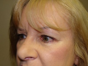 Blepharoplasty Before and After 16 | Sanjay Grover MD FACS