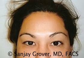 Blepharoplasty Before and After 04 | Sanjay Grover MD FACS