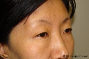 Blepharoplasty Before and After 32 | Sanjay Grover MD FACS