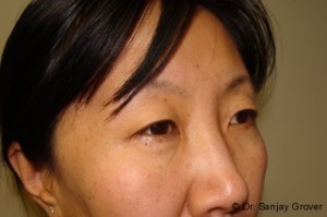 Blepharoplasty Before and After 32 | Sanjay Grover MD FACS