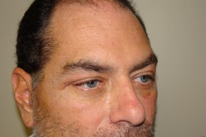 Browlift Before and After 08 | Sanjay Grover MD FACS